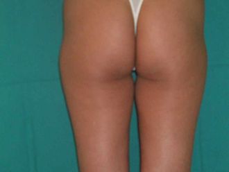 PREOPERATORIO