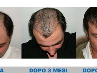 Trapianto di capelli