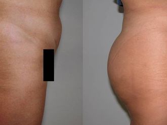 Lifting glutei