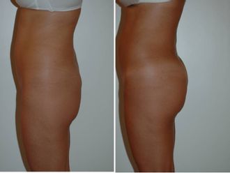 LIPOFILGLUTEO