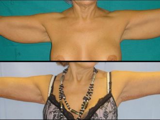 Lifting delle Braccia