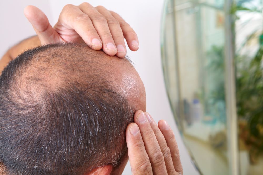 trapianto capelli
