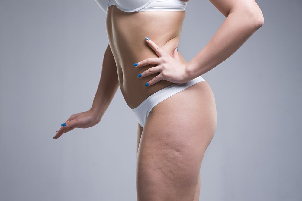 cellulite Acryos