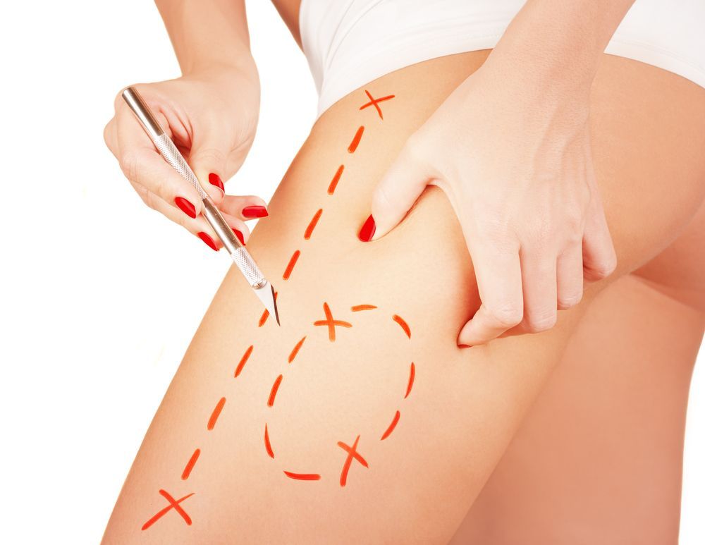 liposuzione e chirurgia estetica