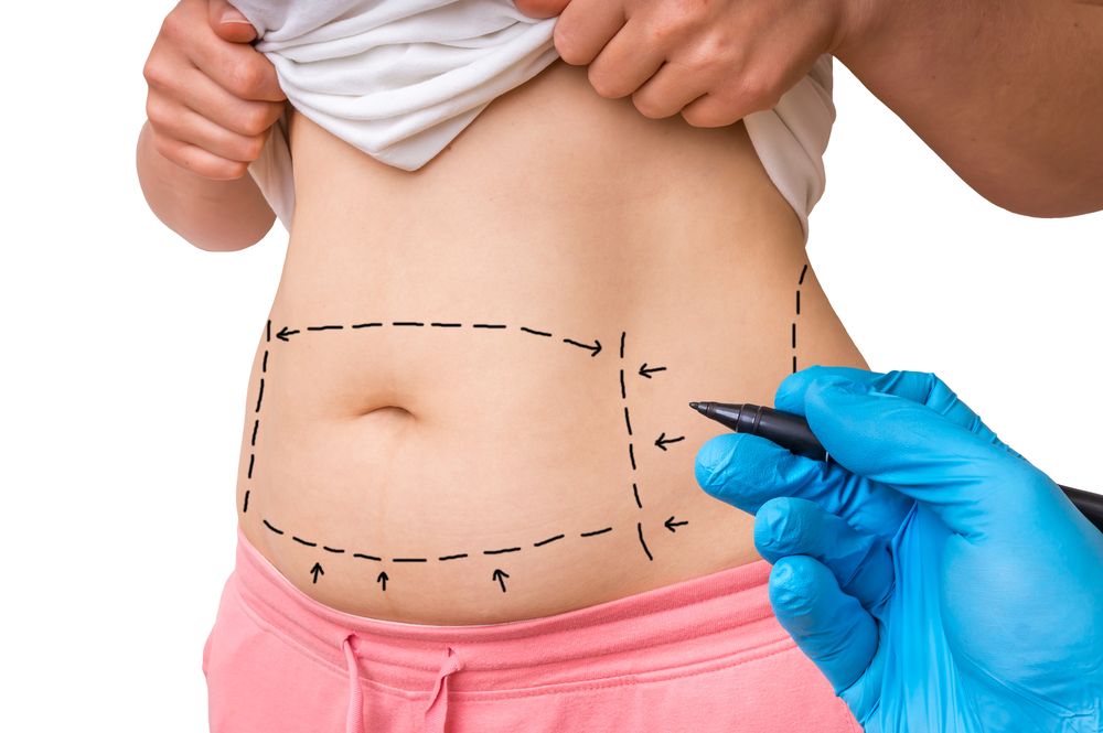 aumento di peso dopo la liposuzione e addominoplastica