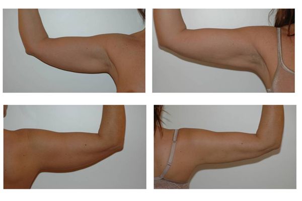 liposuzione braccia