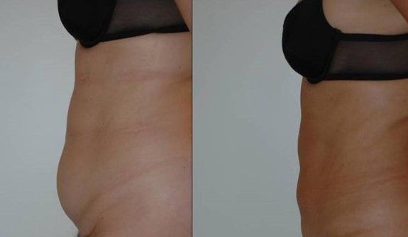 liposuzione addome