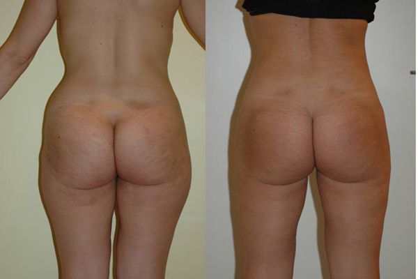 liposuzione glutei