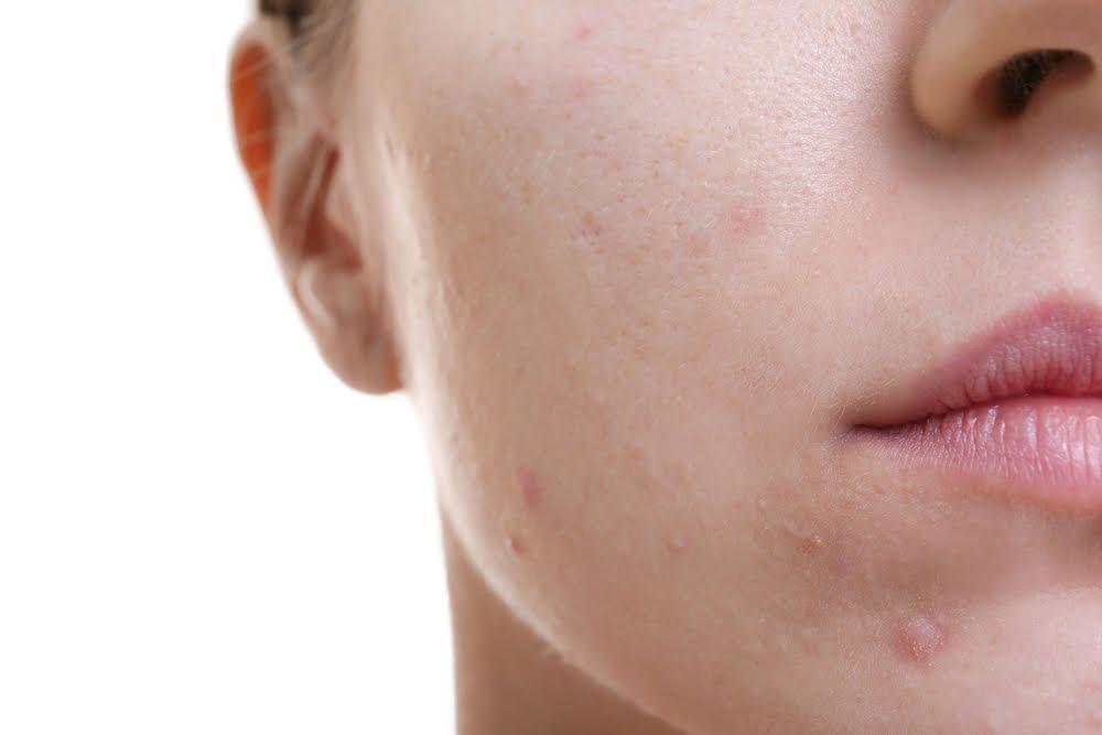 Quanti tipi di acne esistono? Guidaestetica.it